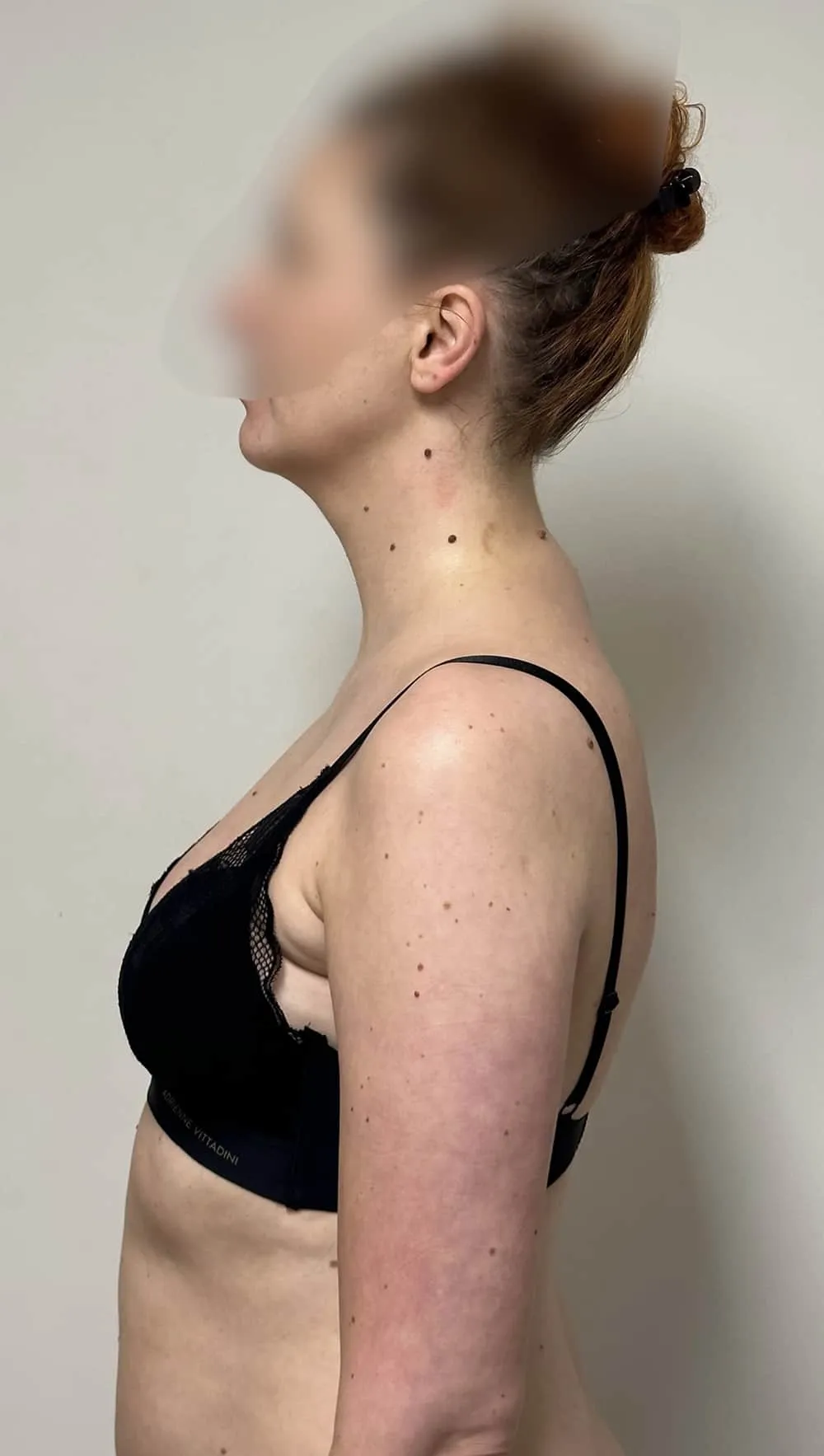 Client after three postural massage treatments