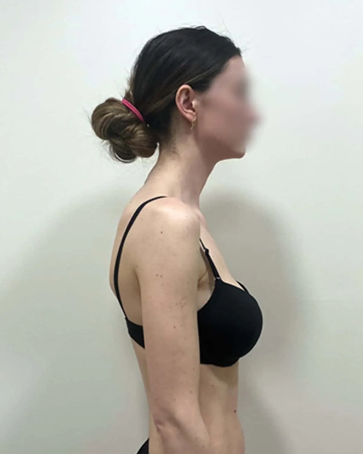 Client before postural massage treatment, showing initial standing posture